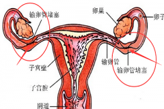 妇炎丸治愈输卵管疾病的案例