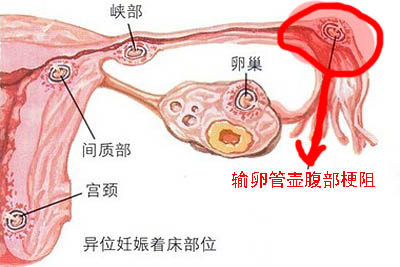 输卵管壶腹部梗阻