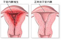 妇炎丸为什么可以治疗子宫内膜增厚