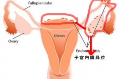 妇炎丸是如何治疗子宫内膜异位症的