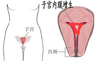 子宫内膜增厚