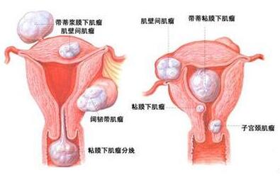 子宫肌瘤导致的盆腔包块