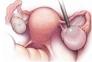 卵巢囊肿型包块