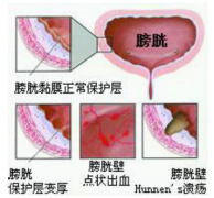 武汉李小平中医是如何来治疗腺性膀胱炎的
