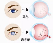 美国研究人员的新发现有望为青光眼带来基因疗法