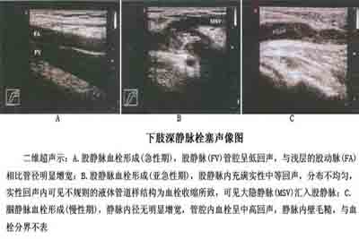 深静脉血栓 深静脉血栓