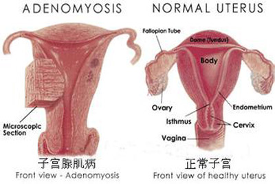 弥漫性子宫腺肌症