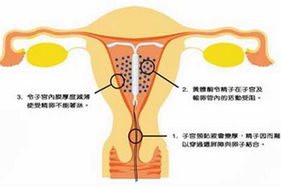 子宫腺肌症的中药治疗