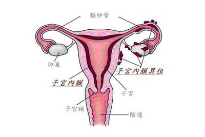 子宫内膜异位的症状