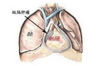 纵隔肿瘤