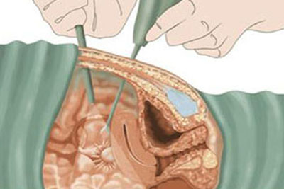 盆腔粘连的手术