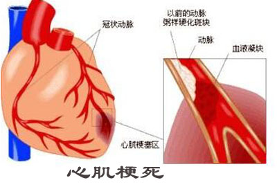 心肌梗死