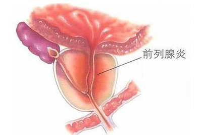 无菌性前列腺炎