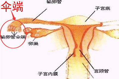 输卵管伞端堵塞