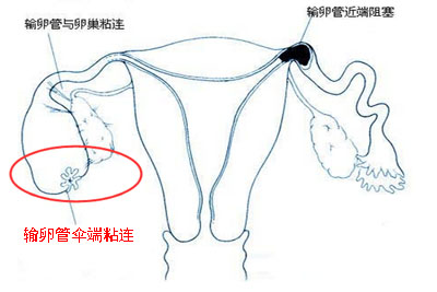 输卵管粘连