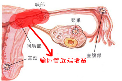 输卵管堵塞