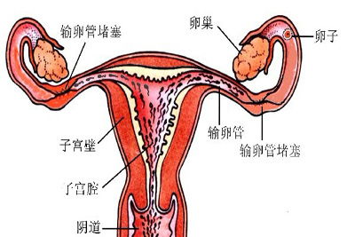 输卵管梗阻