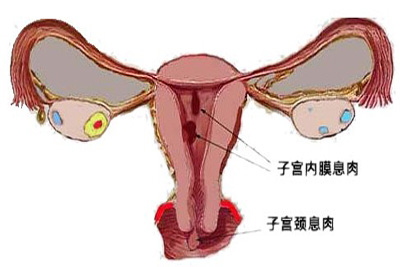 宫颈炎性息肉