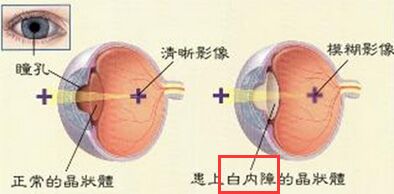 白内障