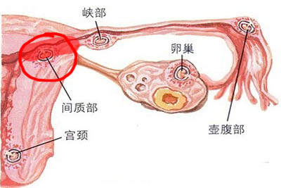 输卵管梗阻