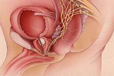 前列腺炎
