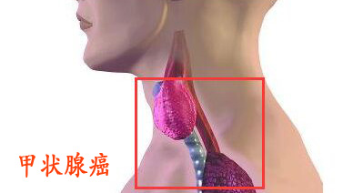 甲状腺癌