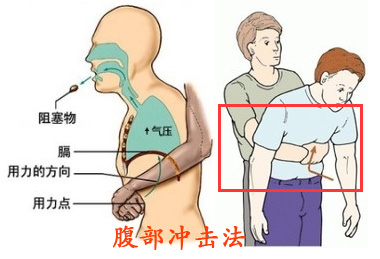 腹部冲击法