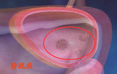 膀胱癌