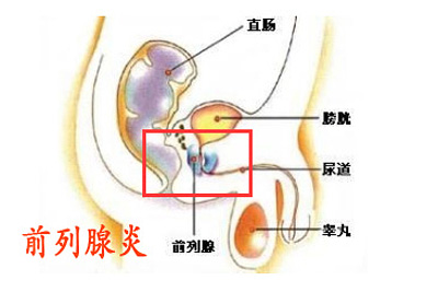 前列腺炎