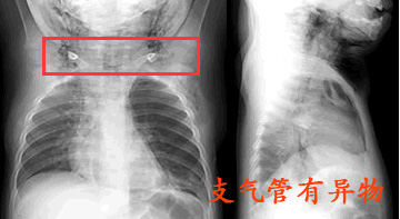 支气管有异物