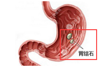 胃结石