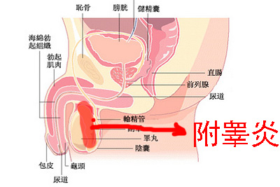 附睾炎