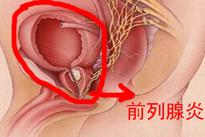 前列腺炎