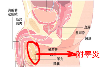 附睾炎