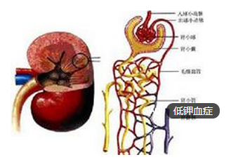 低钾血症