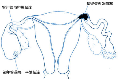 输卵管堵塞