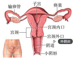 外阴炎