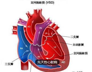 先天性心脏病