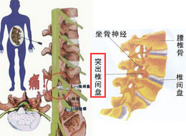 腰椎小关节病变