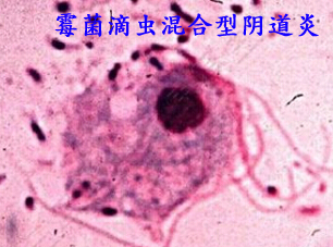 霉菌滴虫混合型阴道炎