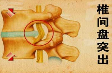 腰椎间盘突出