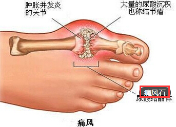 痛风石