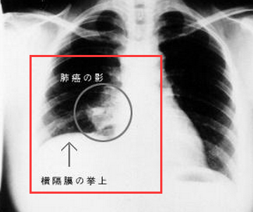 肺部肿瘤