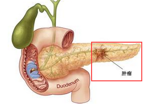 胰腺癌