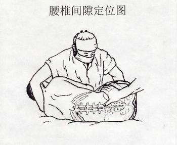 腰椎骨质增生