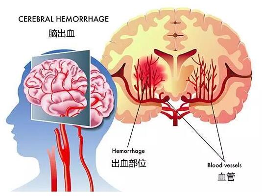 30岁突发脑出血 过度劳累或是诱因