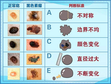 好声音亚军歌手因黑色素瘤去世，如何区分痣还是黑色素瘤?