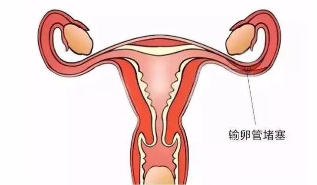 输卵管堵塞中药调理方法有哪些