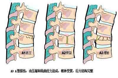 
腰椎骨折