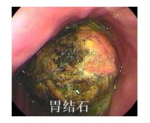 贪吃柿子酿大祸 日积月累形成“柿石”